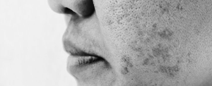 Melasma on Facial Skin